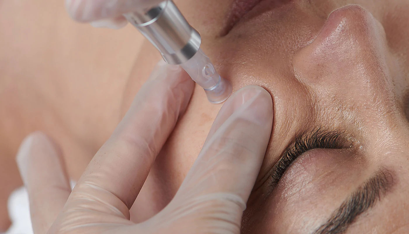 What Is Dermapen Microneedling? Should Brides-To-Be Try It?