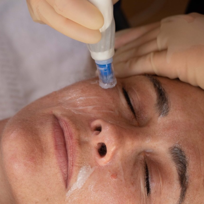 What Is Dermapen Microneedling? Should Brides-To-Be Try It?